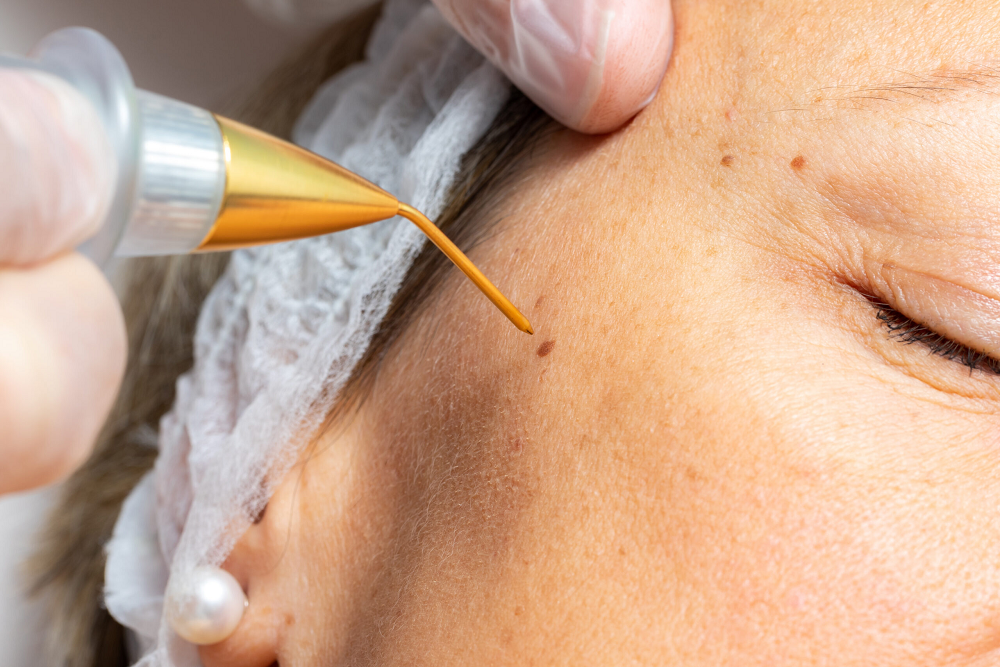 Rimozione non chirurgica fibromi, nevi, verruche con plasma